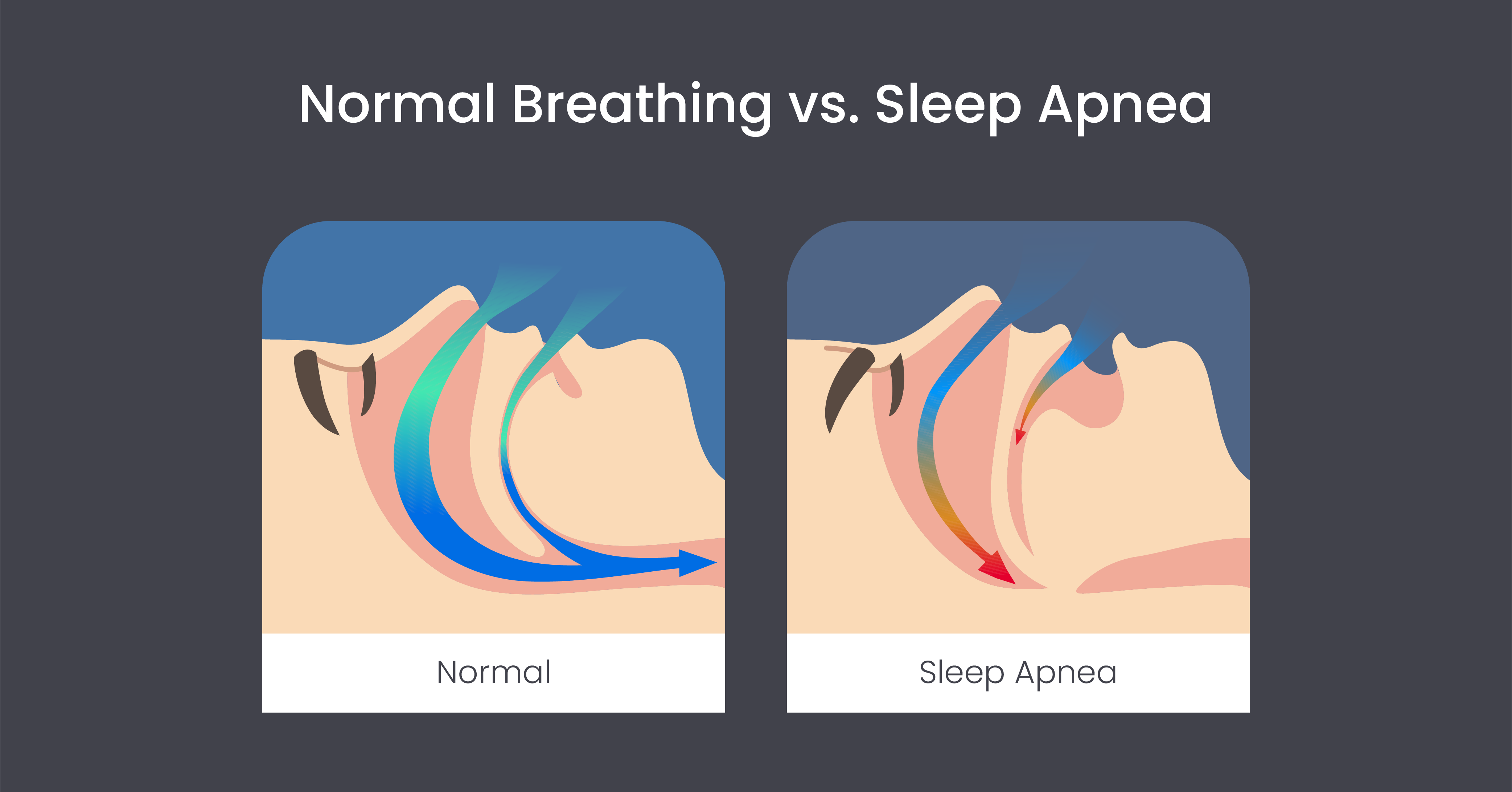 Normal breathing vs. sleep apnea